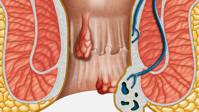 Hemoroid (Basur)