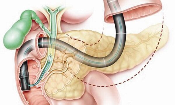 ERCP